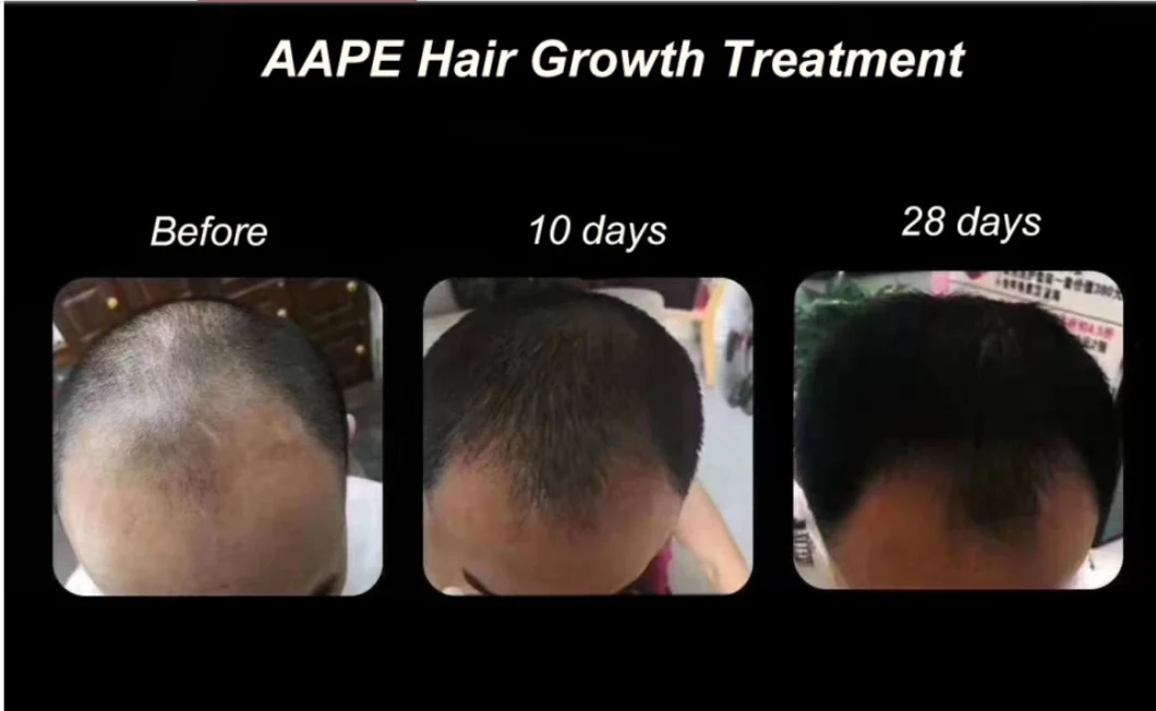 Anti Hair Loss Care Treatment Aape Efficient Hair Growth Stem Cell Women Men Regrowth Factors for Hair-Loss Prevention, Hair-Repairing Filler Injection